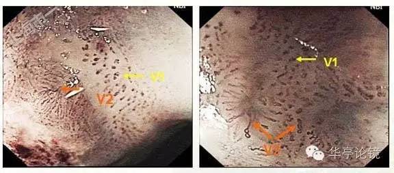 6个精彩病例带你领略早期食管癌的内镜下诊治