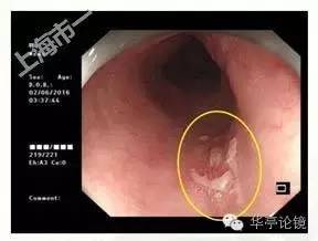 6个精彩病例带你领略早期食管癌的内镜下诊治