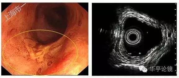 6个精彩病例带你领略早期食管癌的内镜下诊治