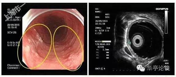 6个精彩病例带你领略早期食管癌的内镜下诊治