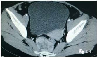 病例丨病理结果「医看2016苏州阅片大赛」病例资料11：血管肌纤维母细胞瘤#医学影像#