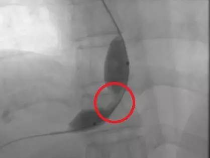 疑难病例|介入血管外科顺利开展布-加综合征的腔内治疗