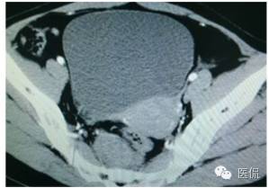 病例丨病理结果「医看2016苏州阅片大赛」病例资料11：血管肌纤维母细胞瘤#医学影像#