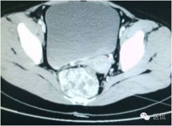 病例丨病理结果「医看2016苏州阅片大赛」病例资料11：血管肌纤维母细胞瘤#医学影像#