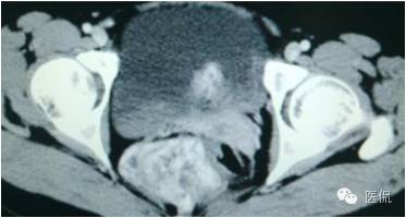病例丨病理结果「医看2016苏州阅片大赛」病例资料11：血管肌纤维母细胞瘤#医学影像#