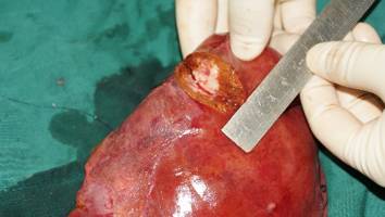 结肠癌同时性肝转移治愈案例,同时性肝转移和异时性肝转移