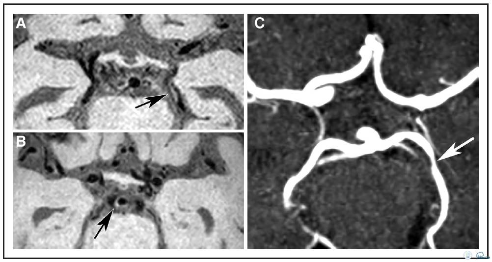 动脉粥样硬化疾病的影像诊断,脑动脉粥样硬化大脑的形态学变化