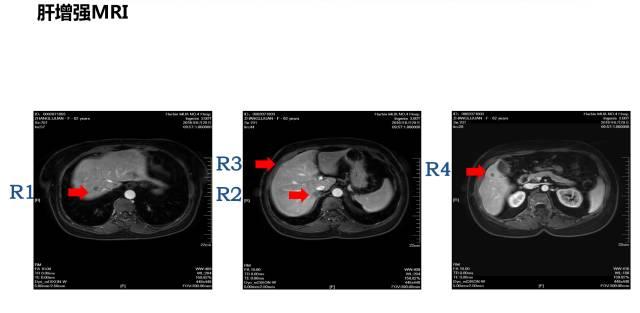结肠癌同时性肝转移治愈案例,同时性肝转移和异时性肝转移