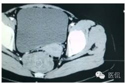 病例丨病理结果「医看2016苏州阅片大赛」病例资料11：血管肌纤维母细胞瘤#医学影像#