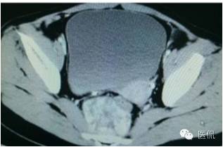 病例丨病理结果「医看2016苏州阅片大赛」病例资料11：血管肌纤维母细胞瘤#医学影像#