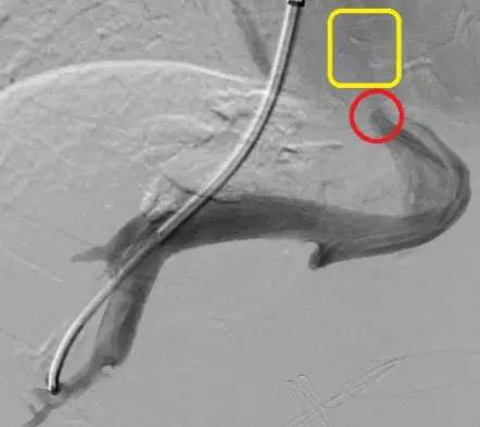 疑难病例|介入血管外科顺利开展布-加综合征的腔内治疗