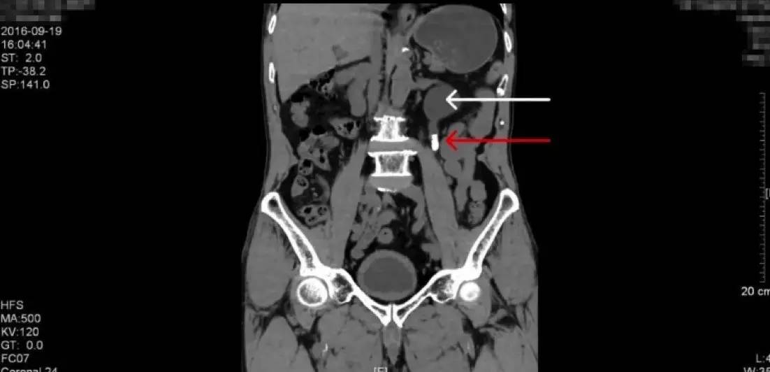 23岁男性泌尿道结石治疗方法,中医治疗输尿管结石独特方法