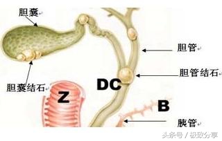 中药治疗胆管结石验方,中药治肝内胆管结石有哪些