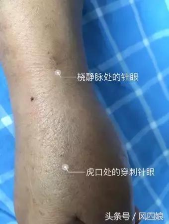 留置针打手背容易鼓包,打留置针后手臂疼怎么办