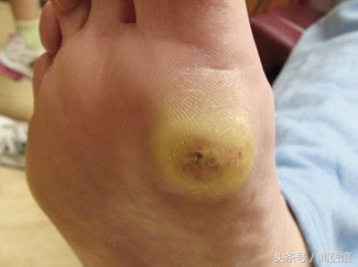 跖疣和湿疣是一种病毒吗,跖疣应与足部的鸡眼和瘊子鉴别