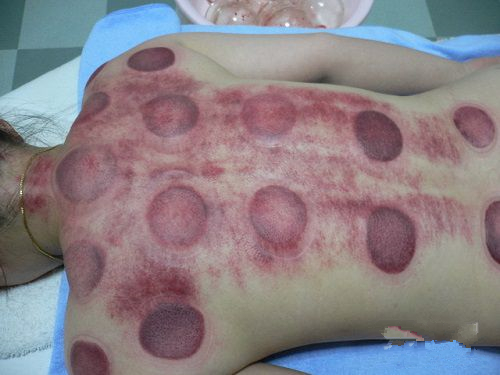 根据拔罐后皮肤的颜色鉴定你的身体到底是怎么了