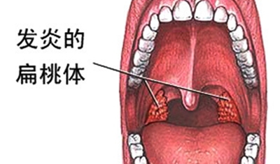 为什么儿童扁桃体发炎反复发烧,孩子反复发烧加扁桃体发炎怎么办