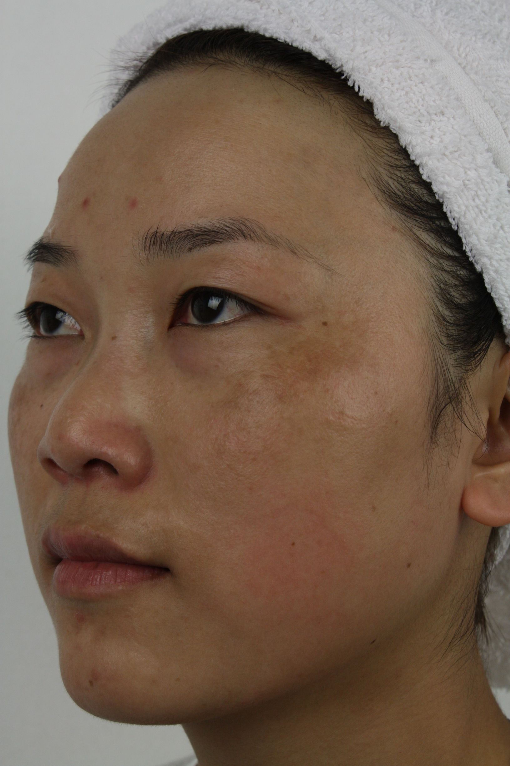 褐青色斑可以淡化吗,褐青色斑和雀斑哪个容易祛