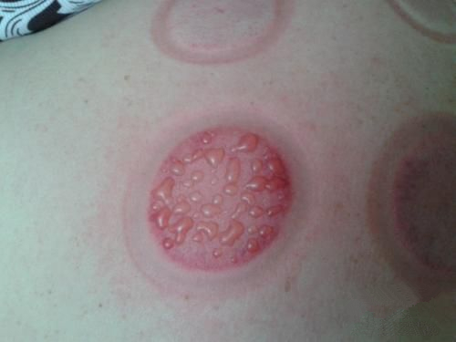 根据拔罐后皮肤的颜色鉴定你的身体到底是怎么了