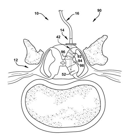 神经干细胞移植修复神经原理,神经干细胞修复大脑皮层