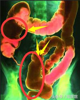 胃痛便秘怎么办简单有效的方法,便秘胃痛