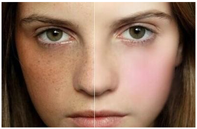 褐青色斑可以淡化吗,褐青色斑和雀斑哪个容易祛