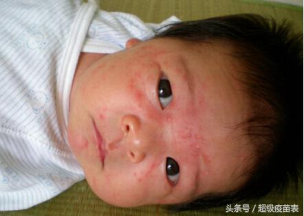 宝宝反复幼儿急疹,幼儿急疹高烧睡着需要叫醒喂药吗