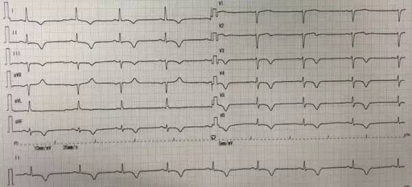 车祸后左胸下方隐隐作痛怎么回事,车祸后胸痛是怎么回事