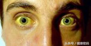 眼睛有红血丝和黄色斑块怎么消除,眼睛周围有黄色斑块怎么回事