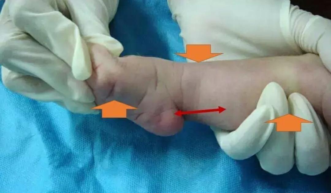 先天性马蹄足内翻可以治愈吗,马蹄足和足内翻是一样的吗