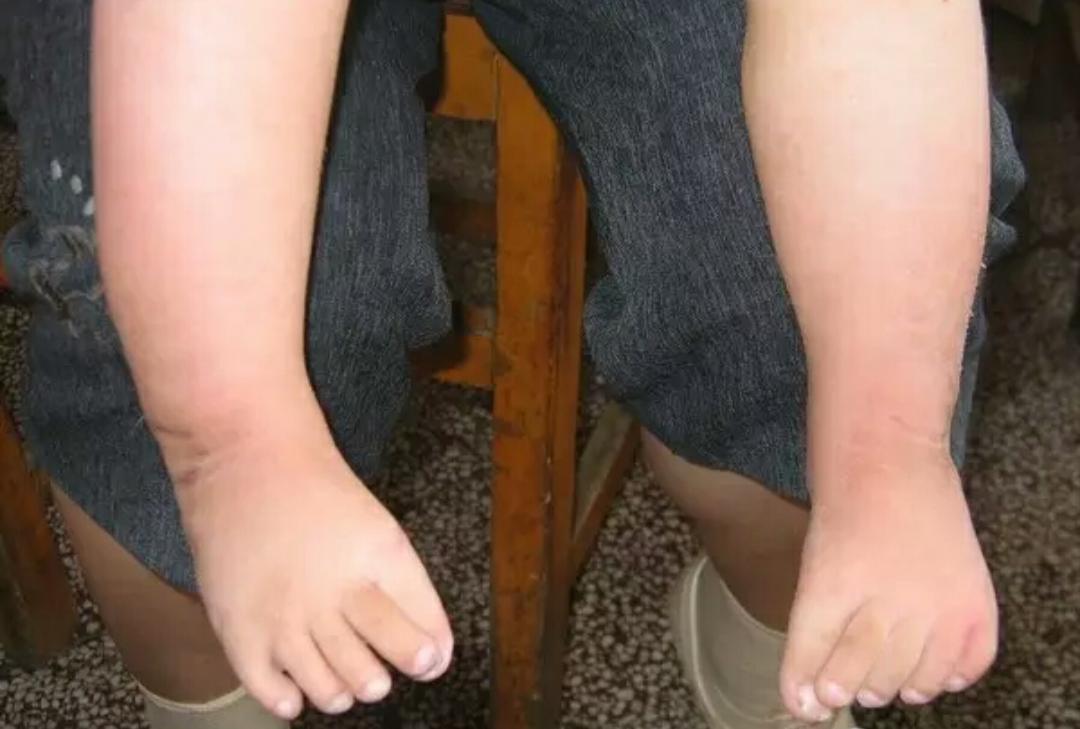 先天性马蹄足内翻可以治愈吗,马蹄足和足内翻是一样的吗