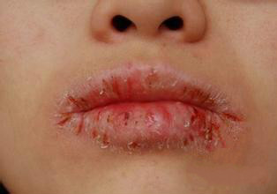 冬季孩子嘴唇红肿干裂老是舔,冬季嘴唇干裂破皮出血怎么办