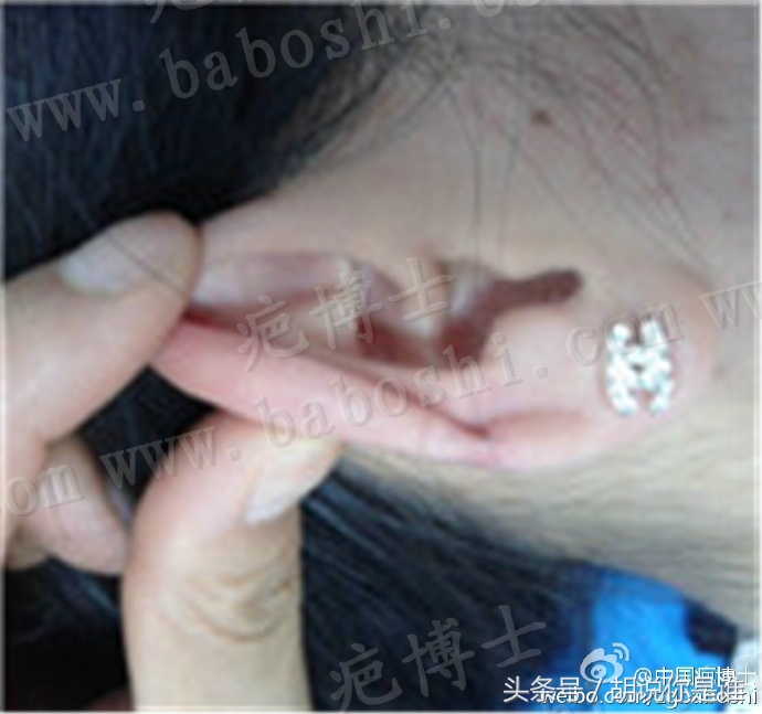 疤痕贴为什么价格悬殊这么大,疤痕一般什么价格