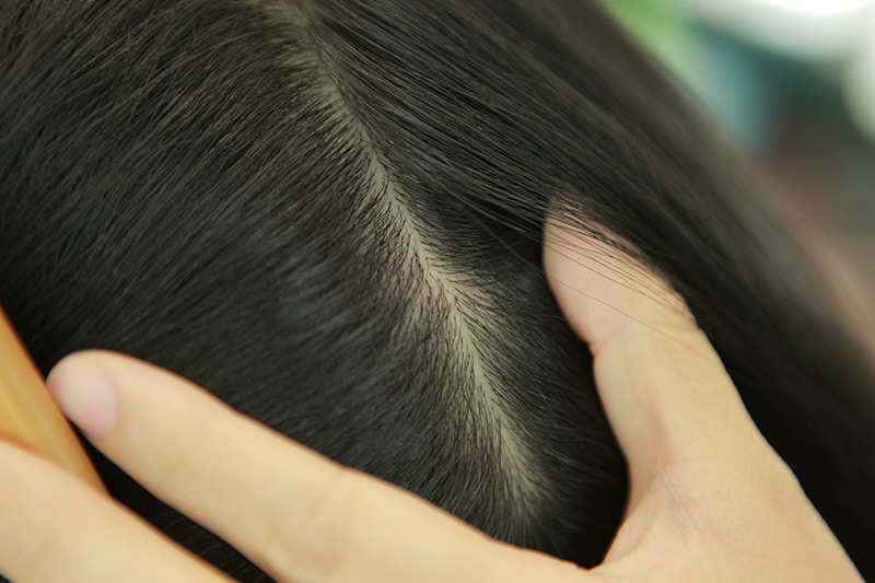 头皮发黄、发红、头屑多、脱发？这是头皮的求救信号！