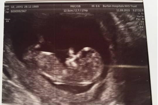 怀孕11周白带突然异常，匆忙赶到医院，检查结果让我生不如死！