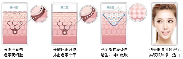 激光后色素沉着会退吗,激光脱毛会色素沉着吗