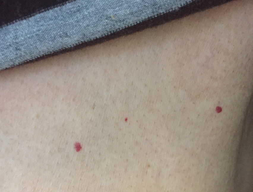 全身出现类似樱桃瘤红点,突然长了一个跟刺猴一样的疙瘩