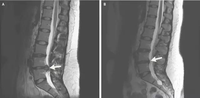 腰椎间盘突出完全不痛才可以锻炼,练背肌对腰椎间盘突出好不好