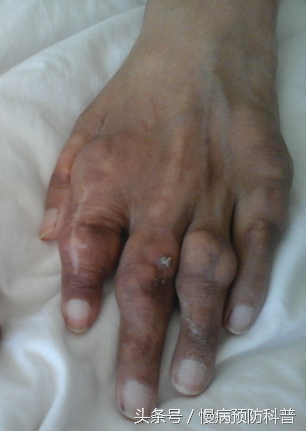 防治痛风最好的办法,防治痛风三款有效食疗秘方