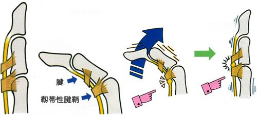 手指生锈了怎么除锈,手指感觉生锈了