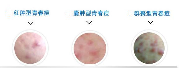 很多人不知道去痘痘,很多人分不清痤疮与毛囊炎