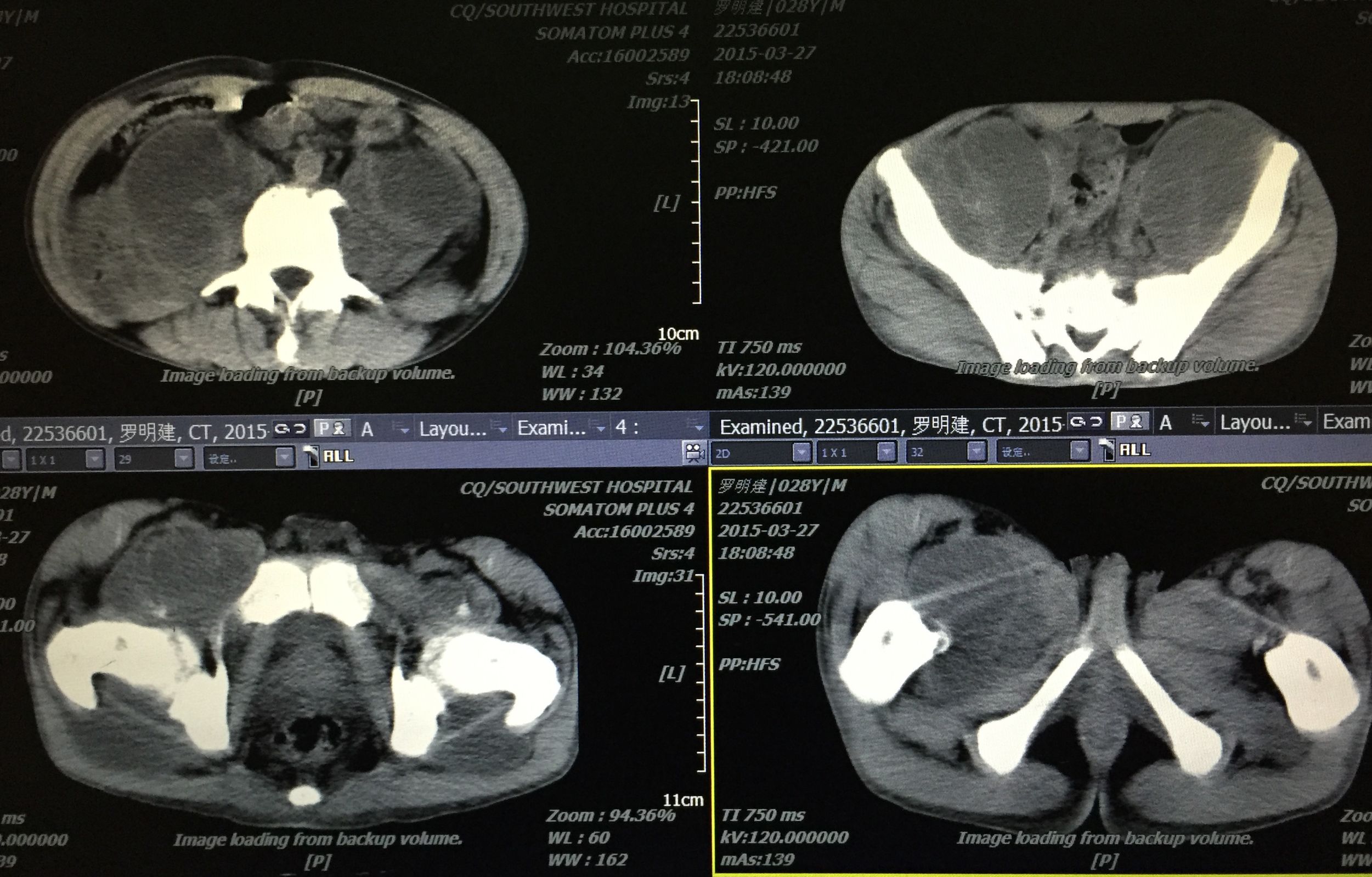 你知道吗？脊柱、盆腔结核脓肿可以穿刺引流联合抗痨治疗。