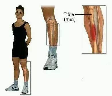 跑步胫骨筋膜炎怎么办,跑步小腿筋膜炎痛多久