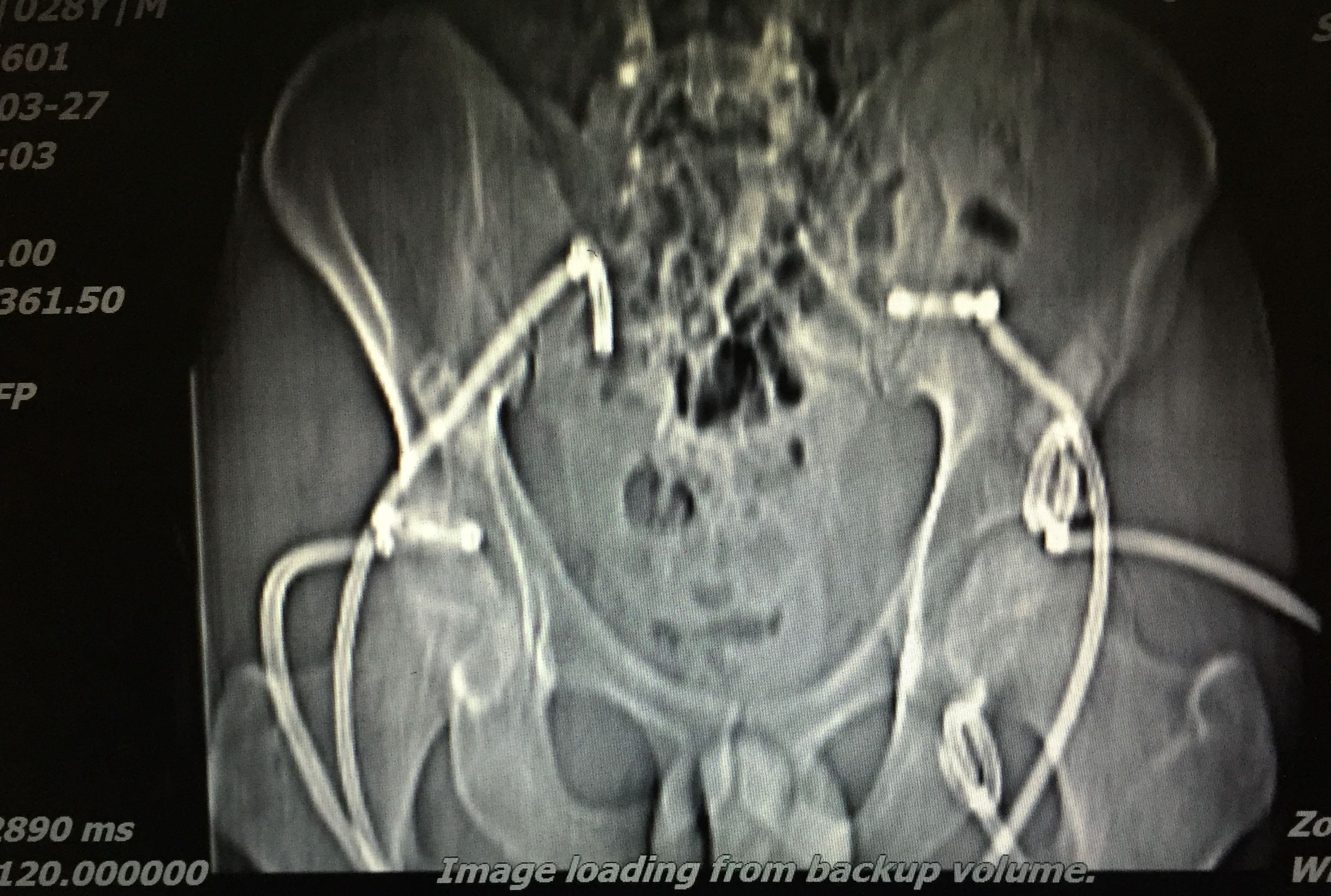 你知道吗？脊柱、盆腔结核脓肿可以穿刺引流联合抗痨治疗。