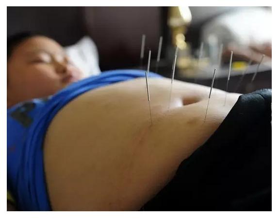 每个胖子都应该看：针灸治疗肥胖症