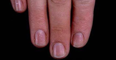 指甲的变化意味着身体的健康状况,指甲上出现这7症状是大病前兆