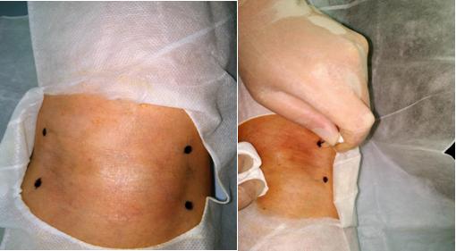 骨性关节炎针刀疗法视频,骨性关节炎损伤