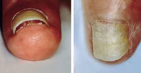 指甲的变化意味着身体的健康状况,指甲上出现这7症状是大病前兆