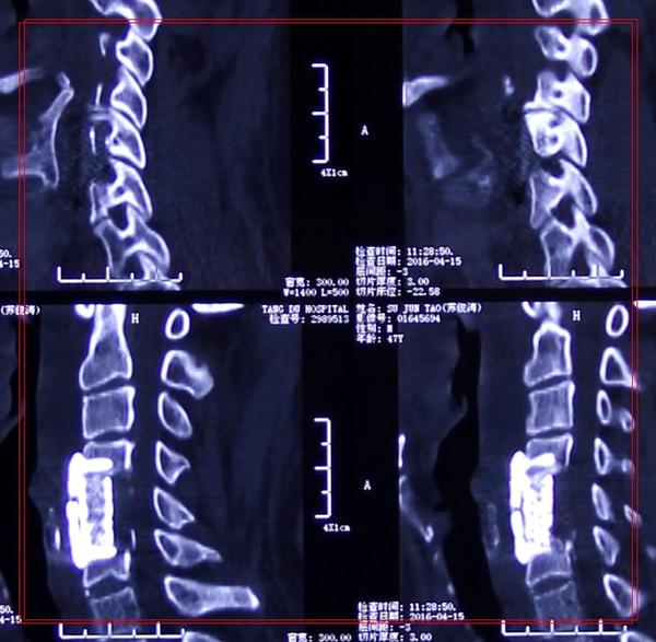 交感型颈椎病忌讳什么锻炼方法,交感型和椎动脉型颈椎病区别