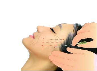 线雕对抗面部衰老的秘密,线雕抗衰依靠三方面的力量